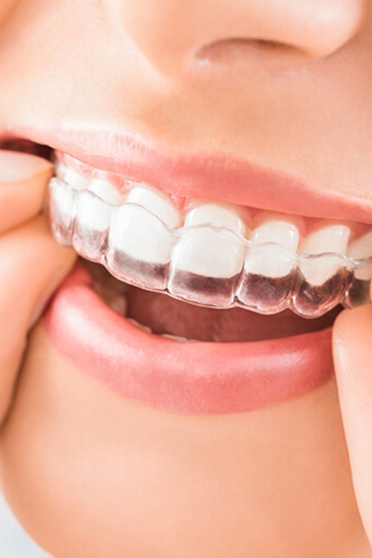 Aparelho invisível colocado nos dentes